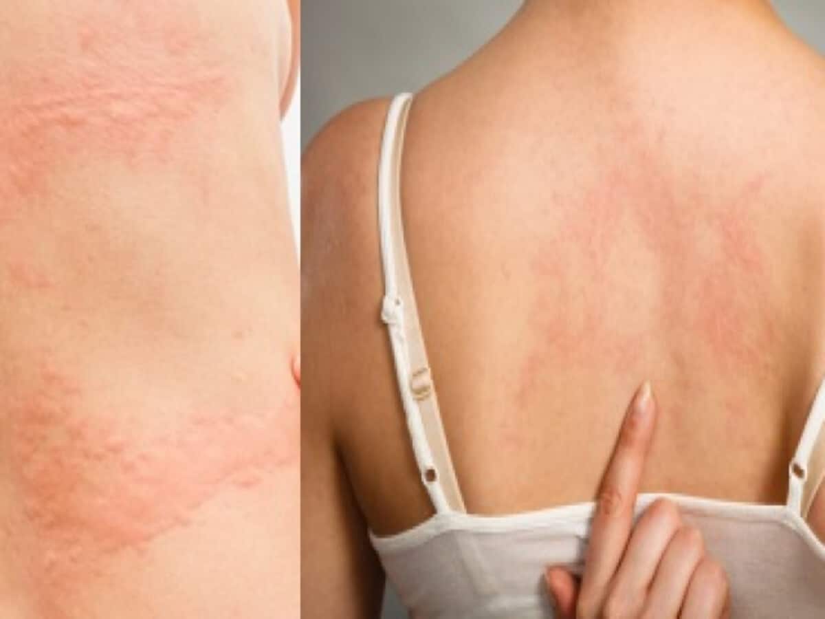 Inshort24 skin care tips best desi home remedies for itchy skin allergy and rashes due to